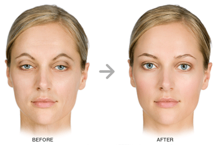 DROOPY UPPER LID