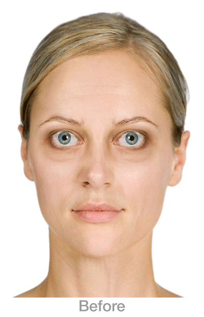 BulgingEye
