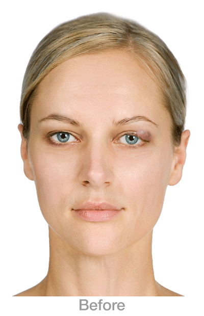 Chalazion