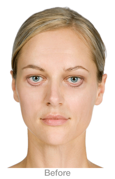 DroopyLowerLids