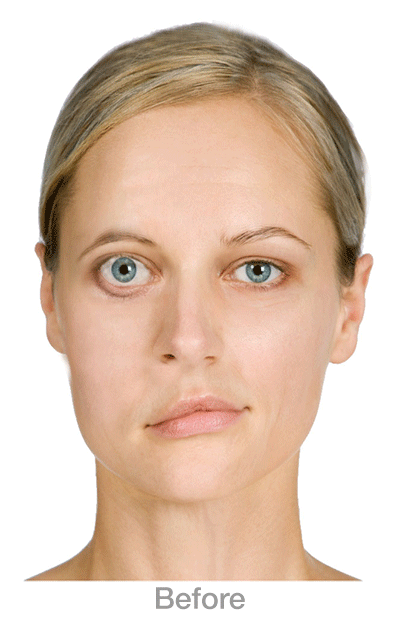 FacialNervePalsy