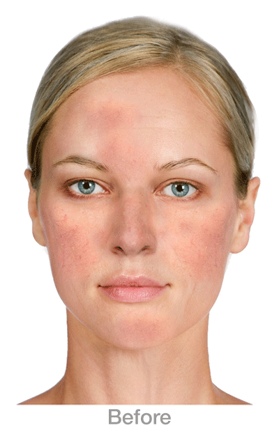 RedspotsRosacea