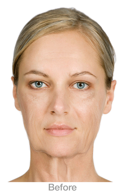 SaggingFaceNeckJawls