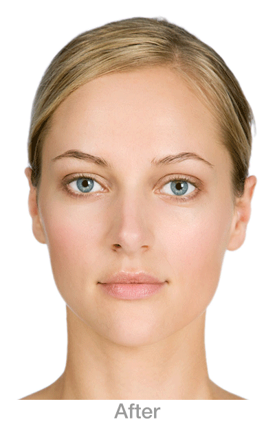 SkinCancerAfter