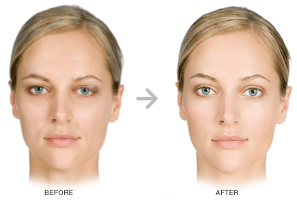 Chalazion