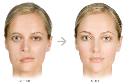 Facial Nervpalsy