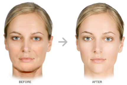 neck face laxity